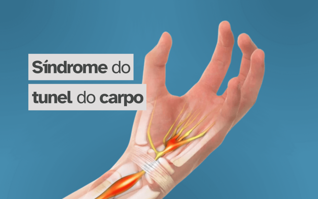 Síndrome do túnel do carpo – Blog