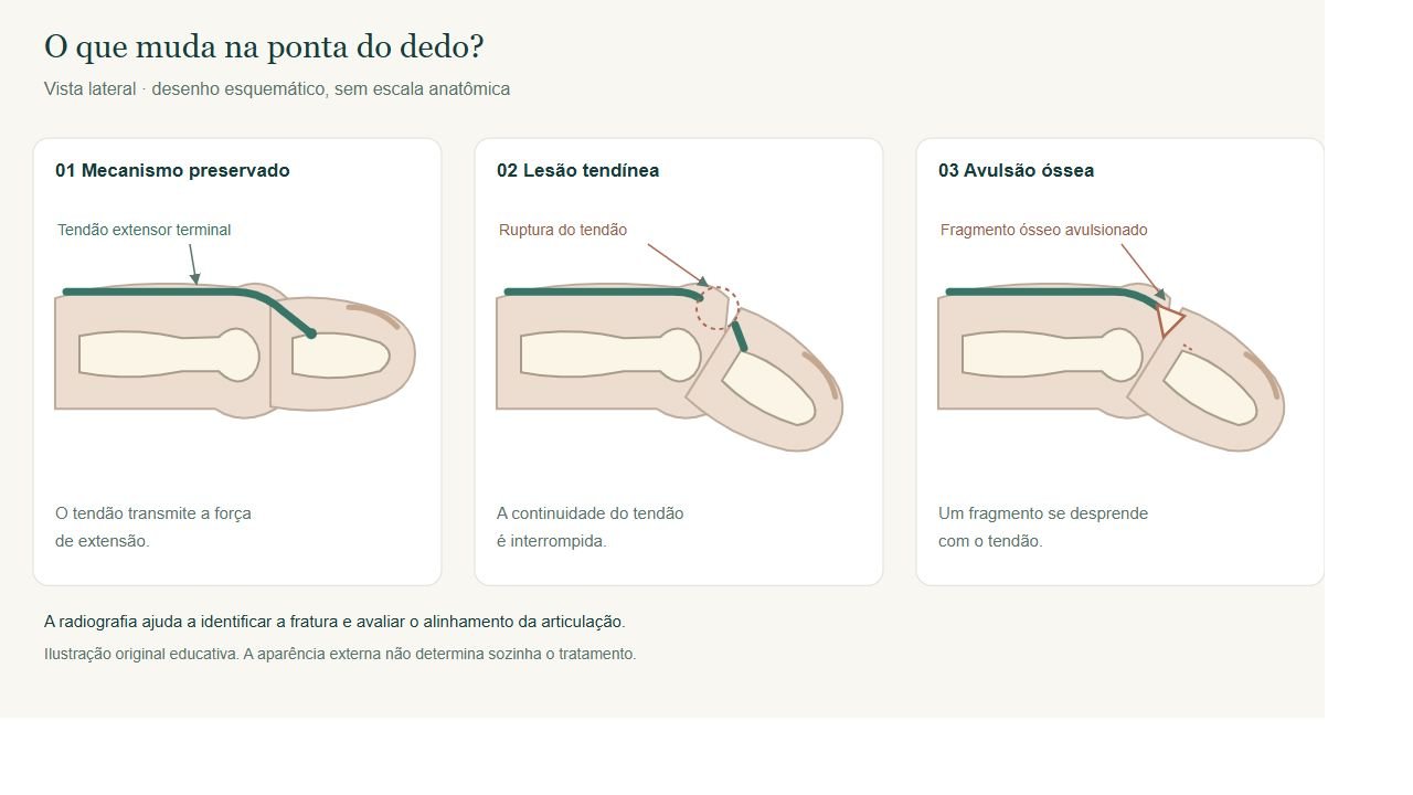 Desenho em vista lateral compara o tendão extensor preservado, sua ruptura e a avulsão de um fragmento ósseo no dedo em martelo.